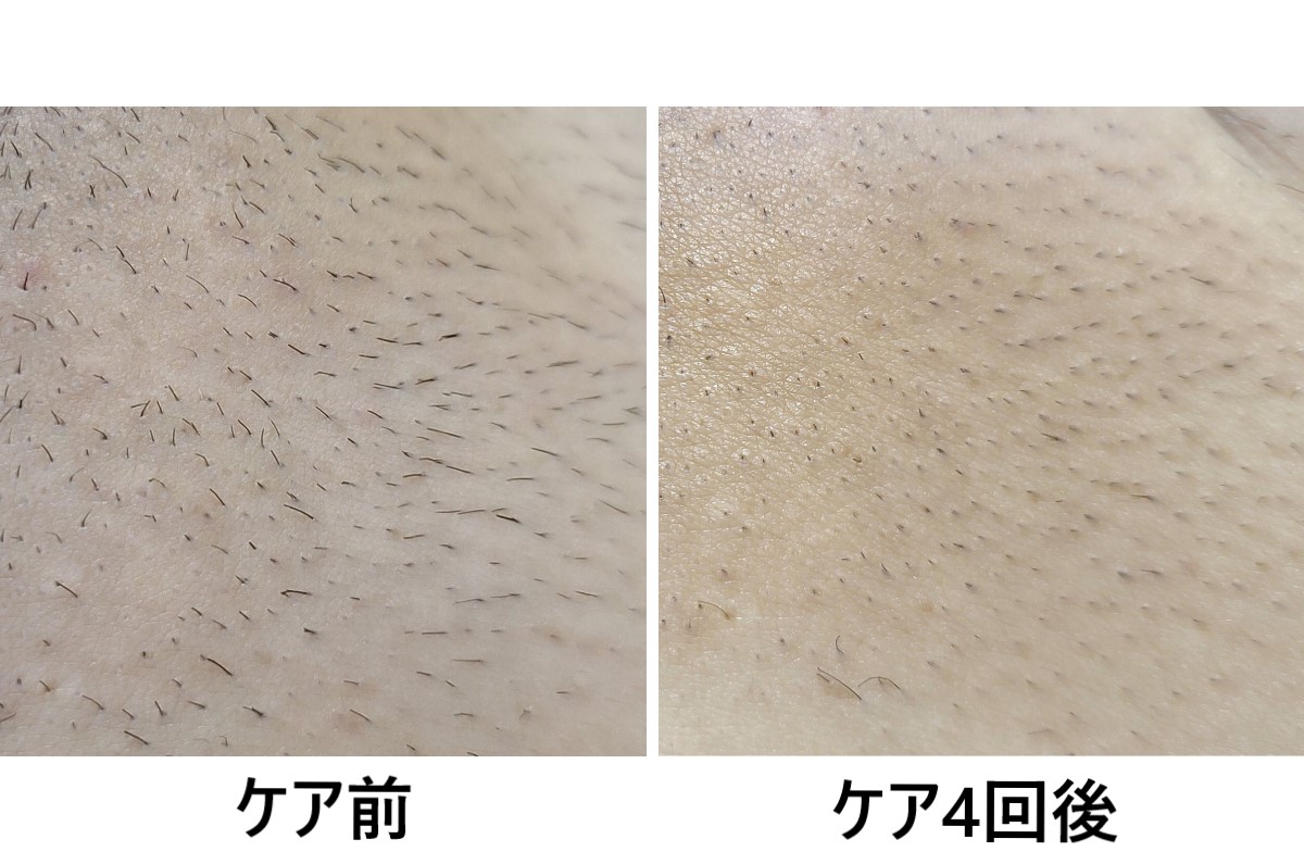 ケア前後の写真（2枚）