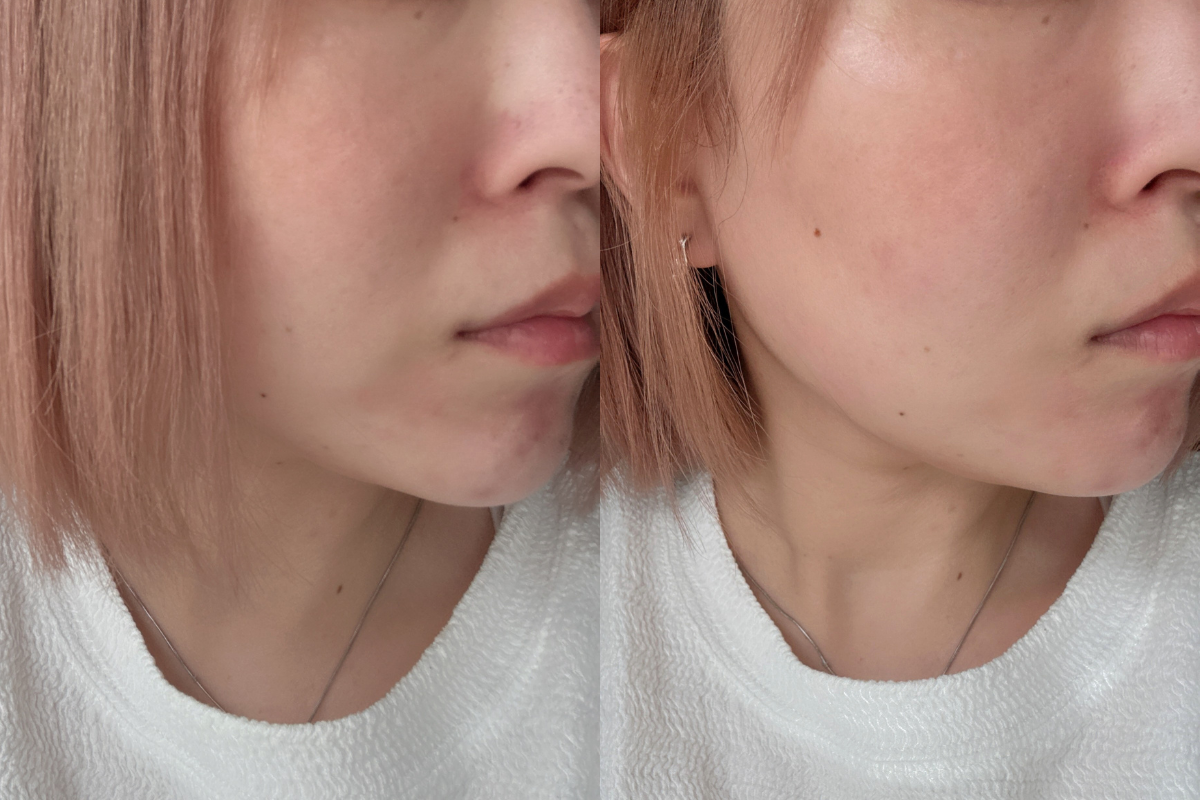 ヤーマン「リフトロジー SP」を使用した画像